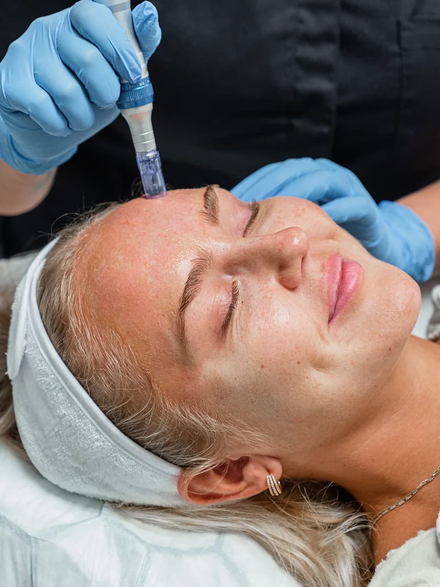 Återhämta och stärk huden med microneedling och PRP