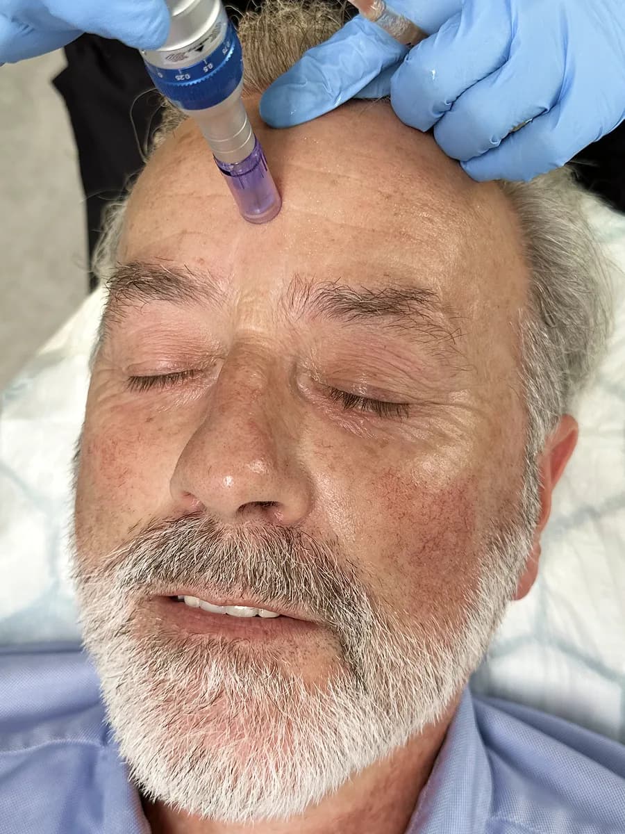Återuppbygg hudens styrka med microneedling och PRP