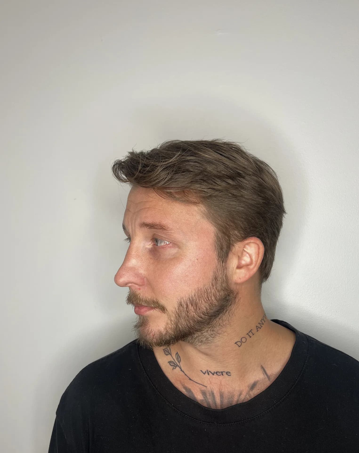 Skäggtransplantation