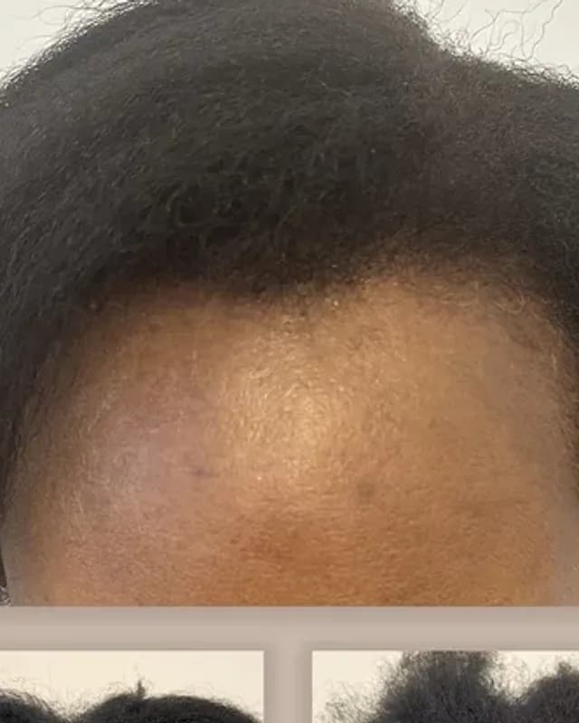 Före och efter hårtransplantation på kvinna, 1 500 grafter med FUE-metoden, resultat efter 8 månader