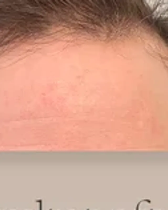 Före hårtransplantation — backande hårlinje