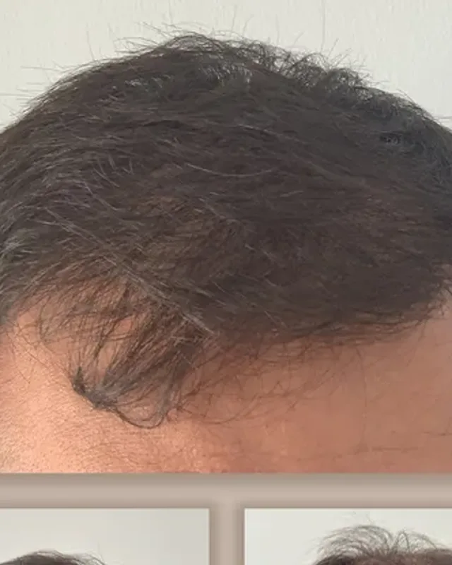 Före och efter hårtransplantation på man, 4 000 grafter med FUE-metoden, resultat efter 12 månader
