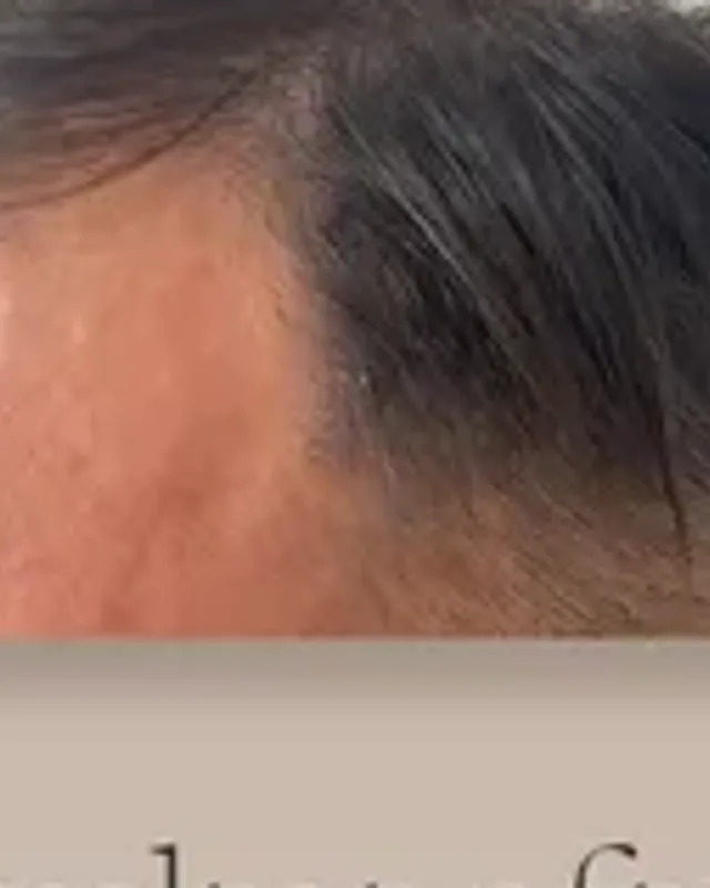Före hårtransplantation, man
