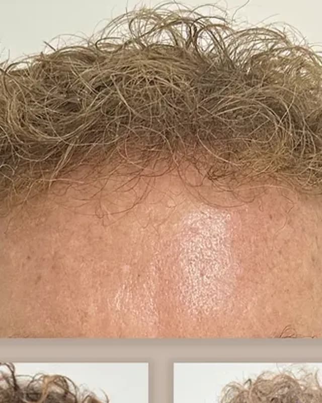 Before and after hair transplant on a man, 4,000 grafts with the FUE method, result after 12 months