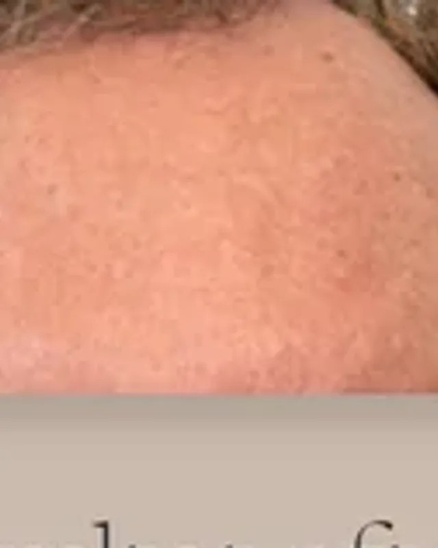 Before hair transplant, man