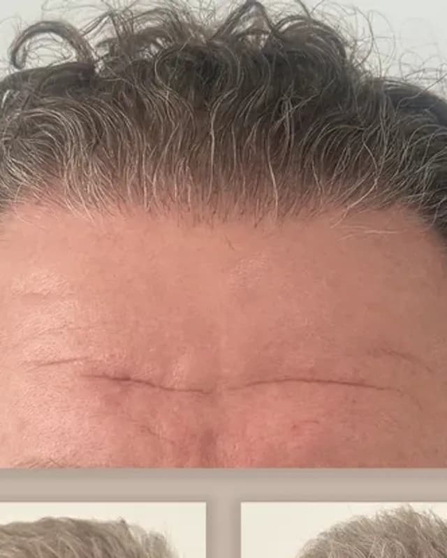Before and after hair transplant on a man, 4,000 grafts with the FUE method, result after 12 months