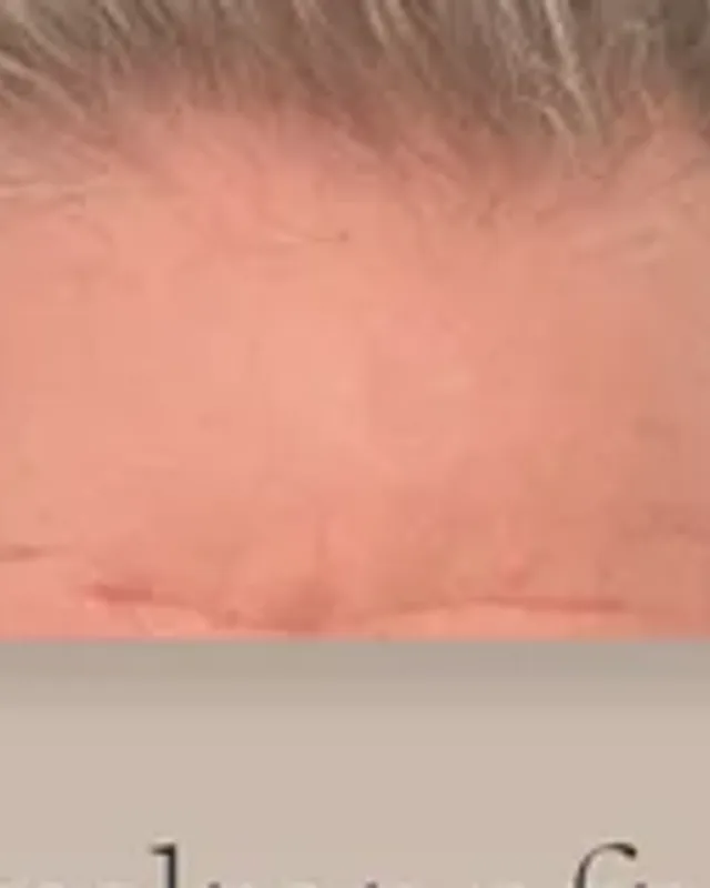 Before hair transplant, man