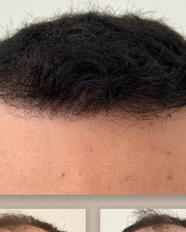 Before and after hair transplant on a man, 4,500 grafts with the FUE method, result after 12 months