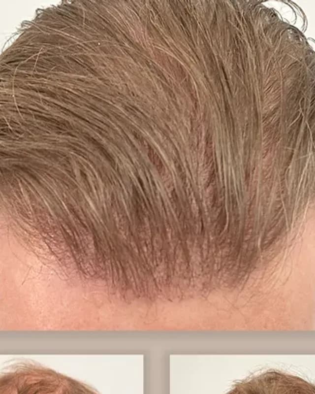 Before and after hair transplant on a man, 4,000 grafts with the FUE method, result after 12 months