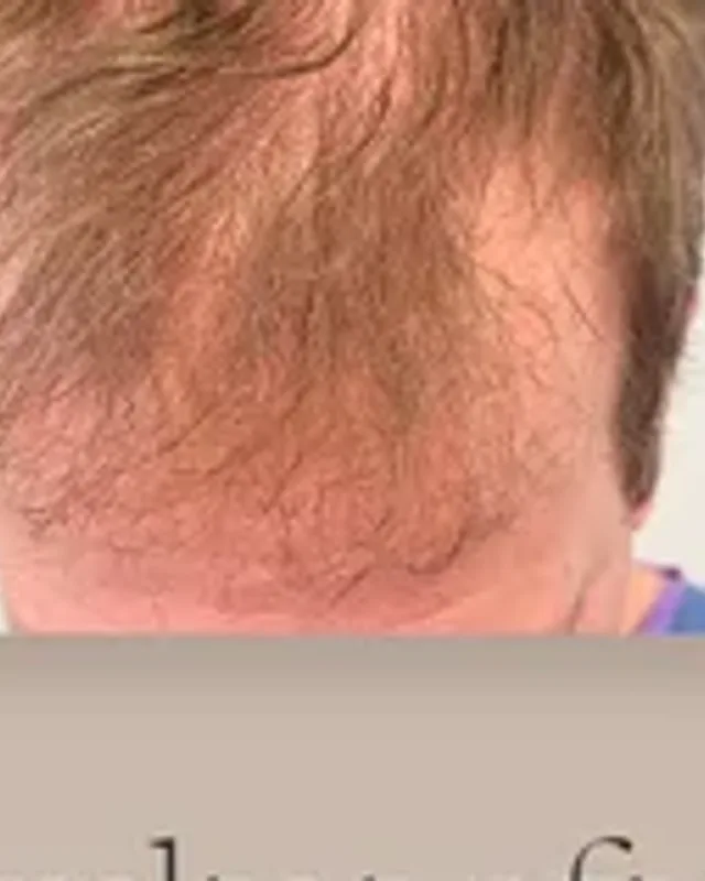 Before hair transplant, man