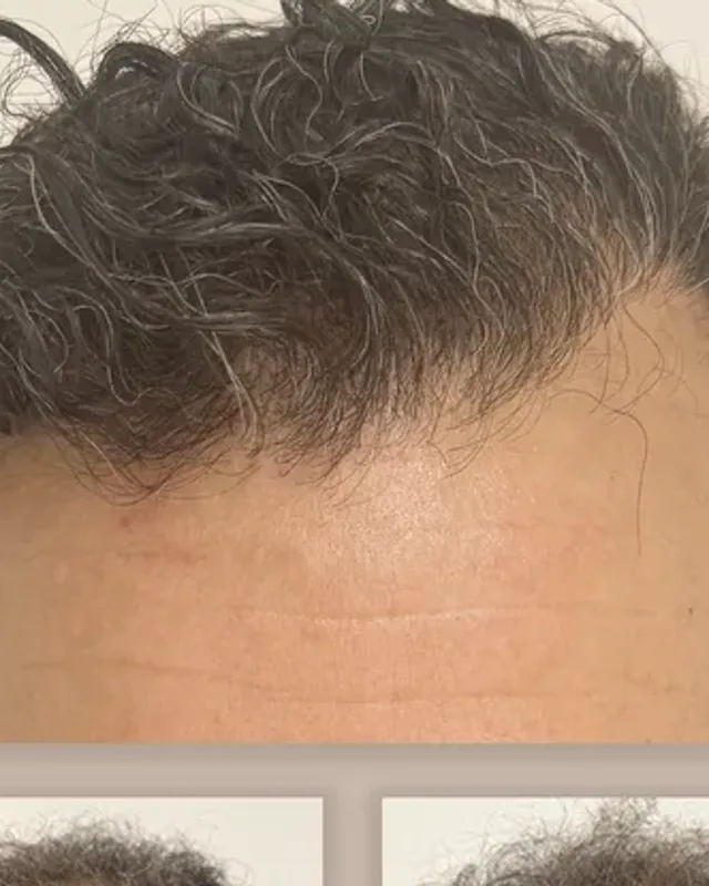 Before and after hair transplant on a man, 4,000 grafts with the FUE method, result after 12 months