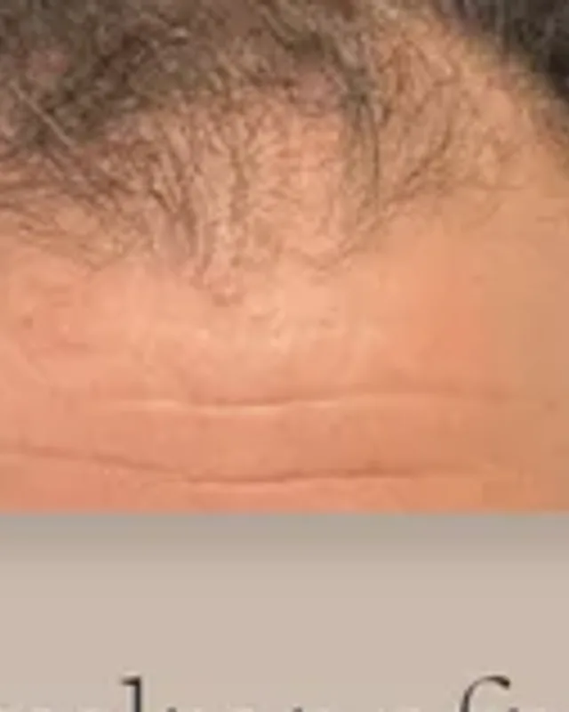Before hair transplant, man