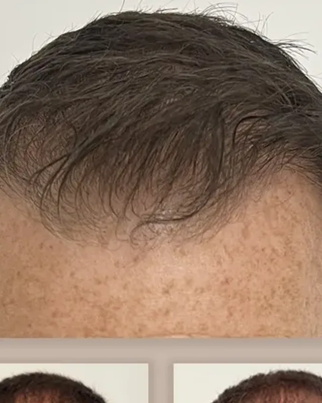 Before and after hair transplant on a man, 3,000 grafts with the DHI method, result after 12 months