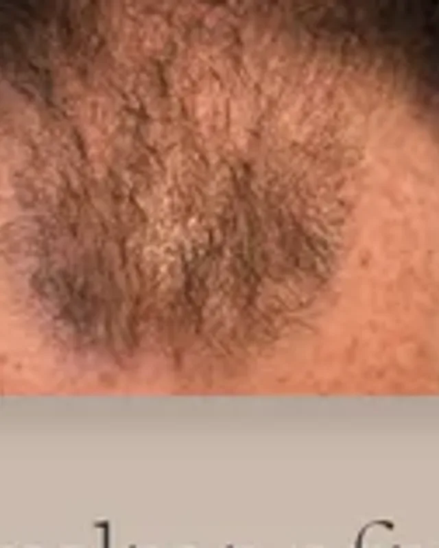 Before hair transplant, man
