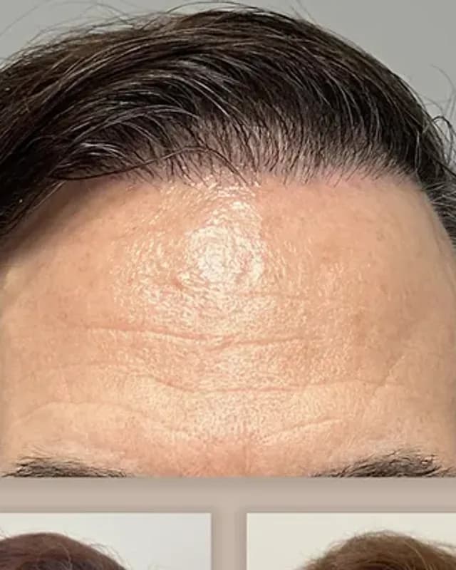Before and after hair transplant on a man, 4,500 grafts with the DHI method, result after 18 months
