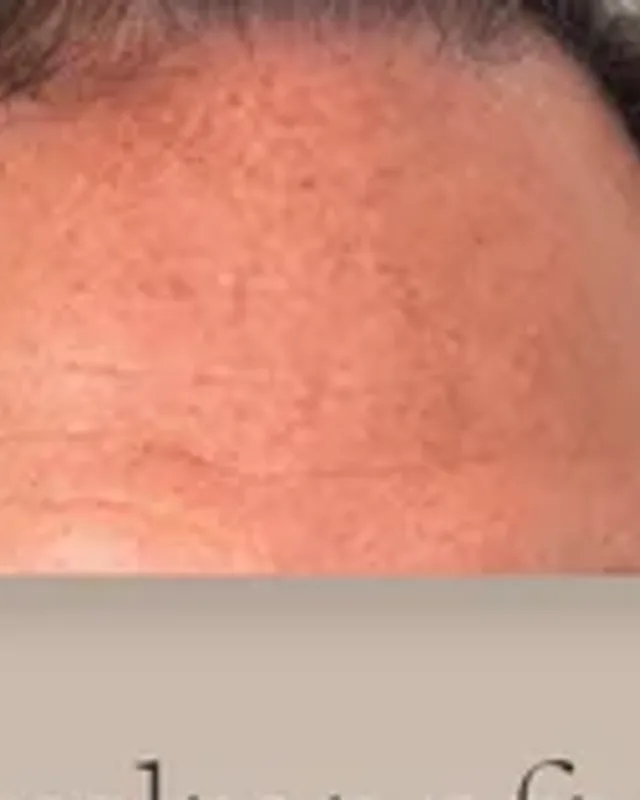 Before hair transplant, man