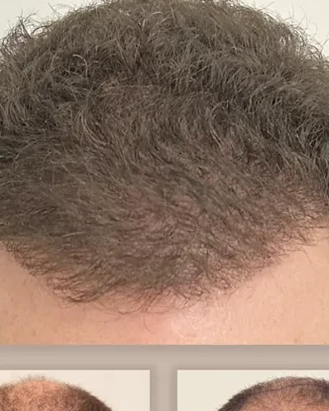 Before and after hair transplant on a man, 1,500 grafts with the FUE method, result after 12 months