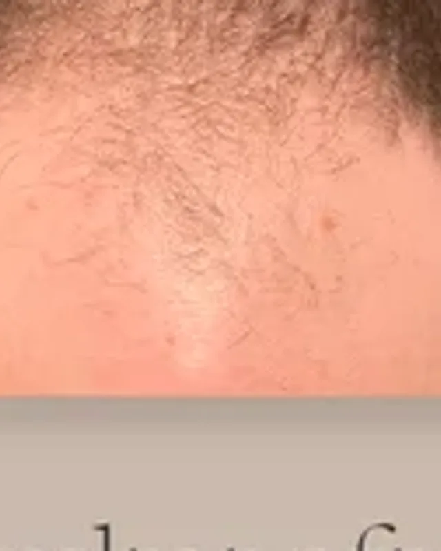 Before hair transplant, man