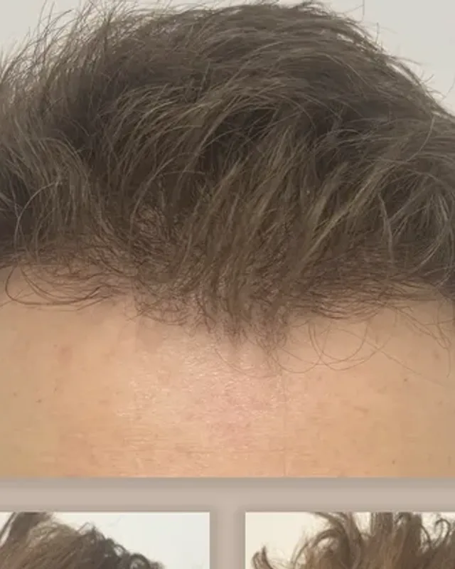 Before and after hair transplant on a man, 2,000 grafts with the FUE method, result after 7 months