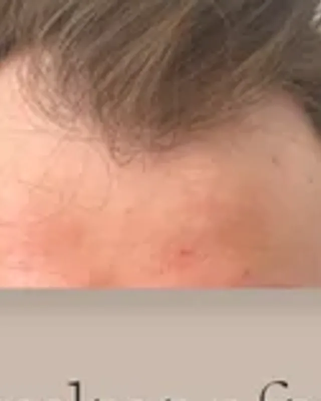 Before hair transplant, man