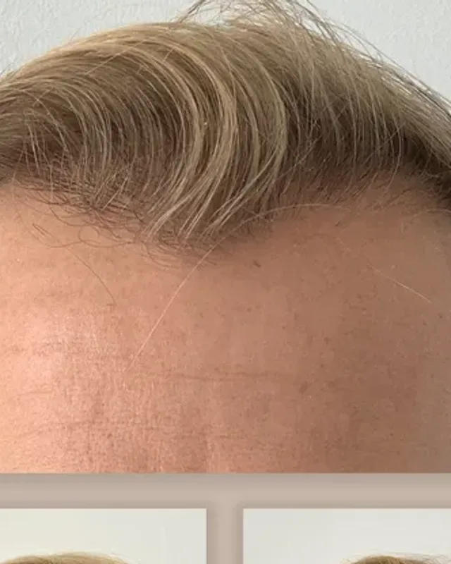 Before and after hair transplant on a man, 4,000 grafts with the DHI method, result after 8 months