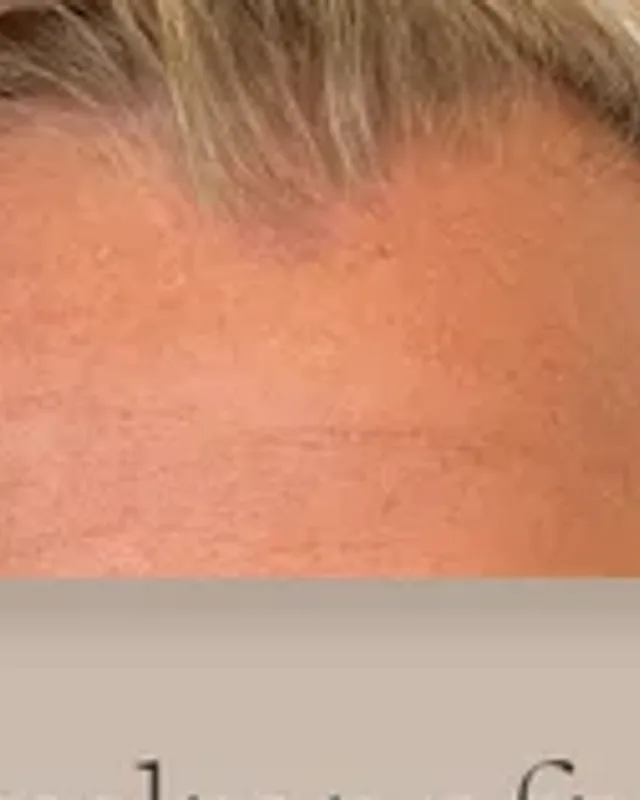 Before hair transplant, man