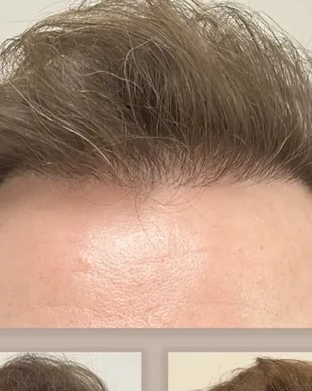 Before and after hair transplant on a man, 2,000 grafts with the DHI method, result after 8 months