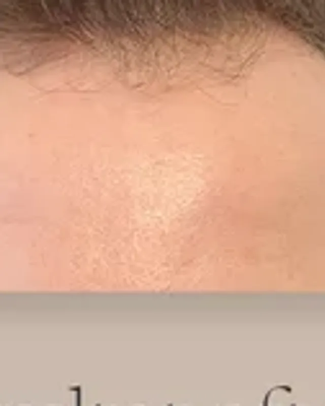 Before hair transplant, man