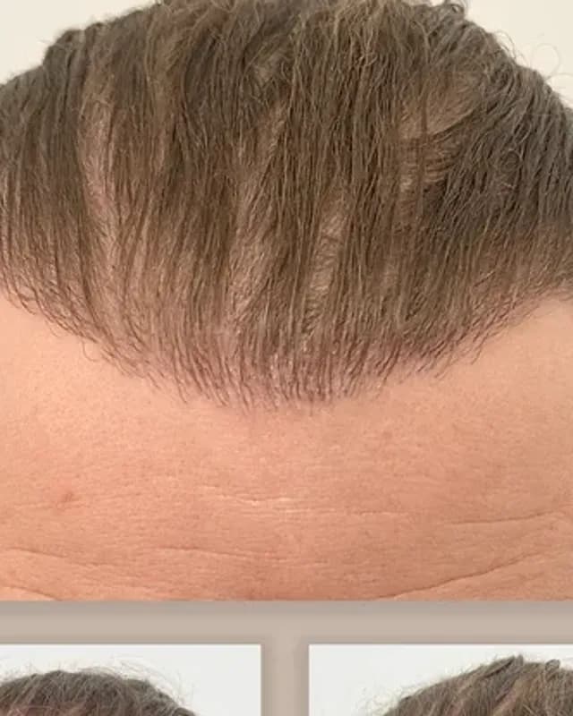 Before and after hair transplant on a man, 2,000 grafts with the DHI method, result after 12 months