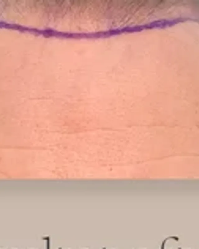 Before hair transplant, man