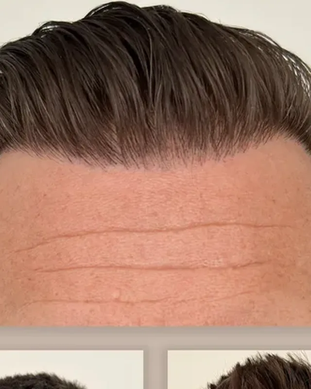 Before and after hair transplant on a man, 2,500 grafts with the FUE method, result after 12 months