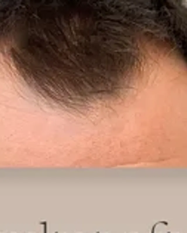Before hair transplant, man