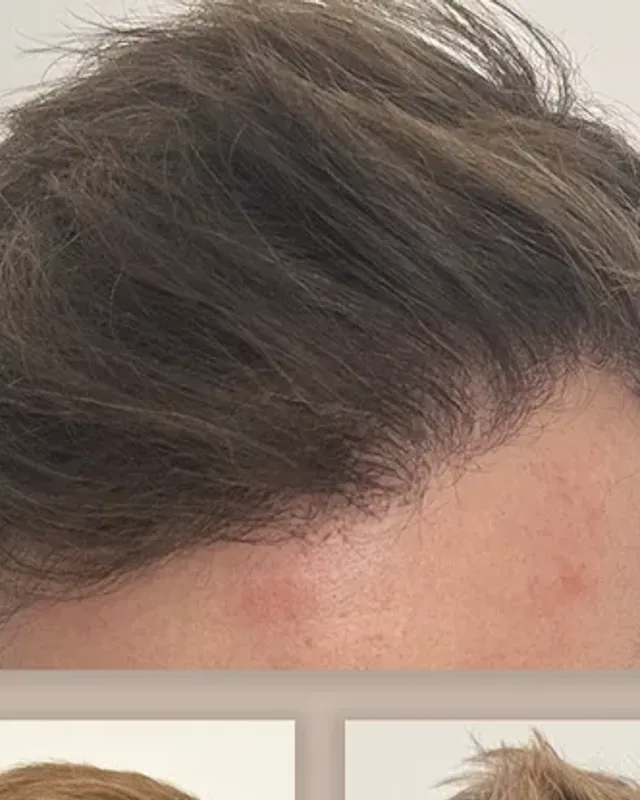 Before and after hair transplant on a man, 3,000 grafts with the FUE method, result after 12 months