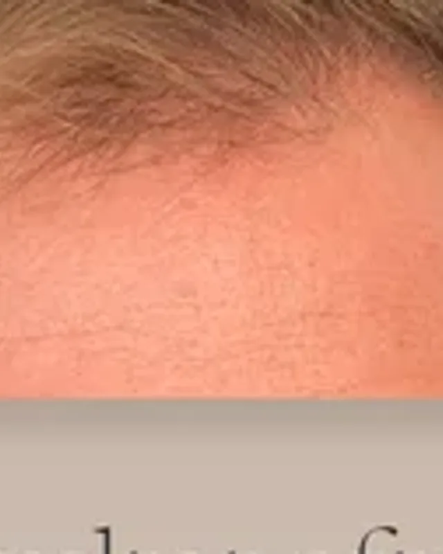 Before hair transplant, man