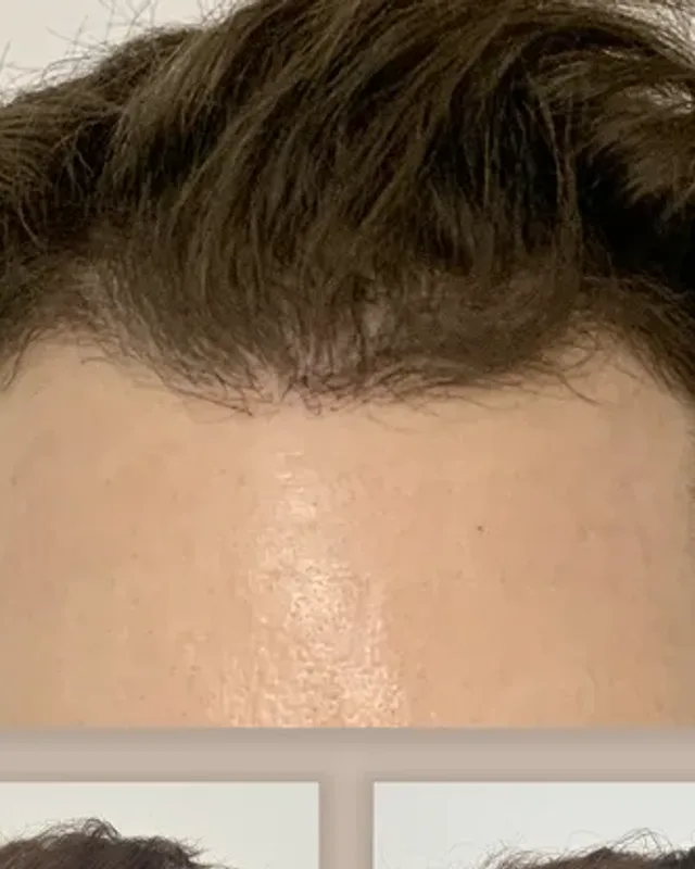 Before and after hair transplant on a man, 2,000 grafts with the DHI method, result after 12 months