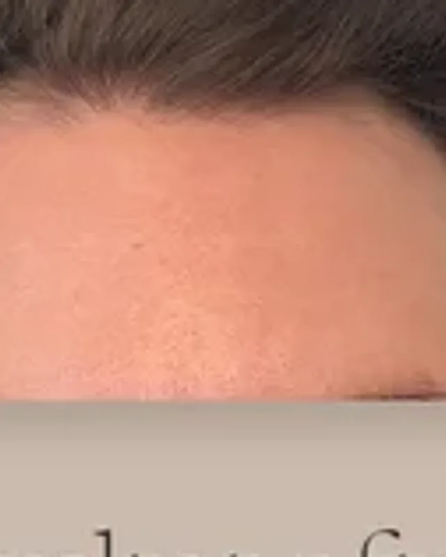 Before hair transplant, man