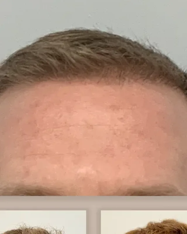 Before and after hair transplant on a man, 1,500 grafts with the DHI method, result after 5 months