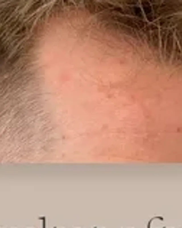 Before hair transplant, man
