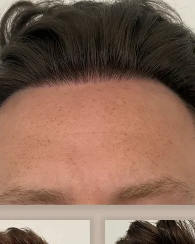 Before and after hair transplant on a man, 4,000 grafts with the DHI method, result after 12 months