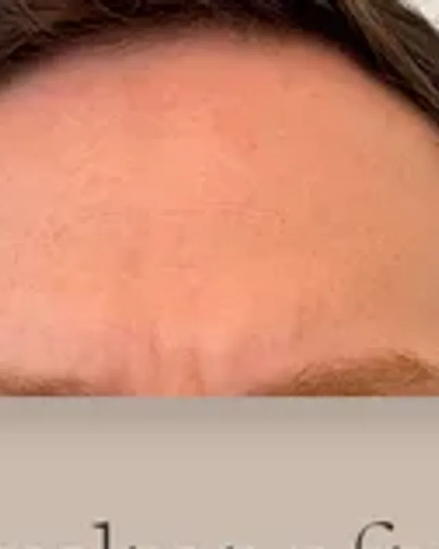 Before hair transplant, man