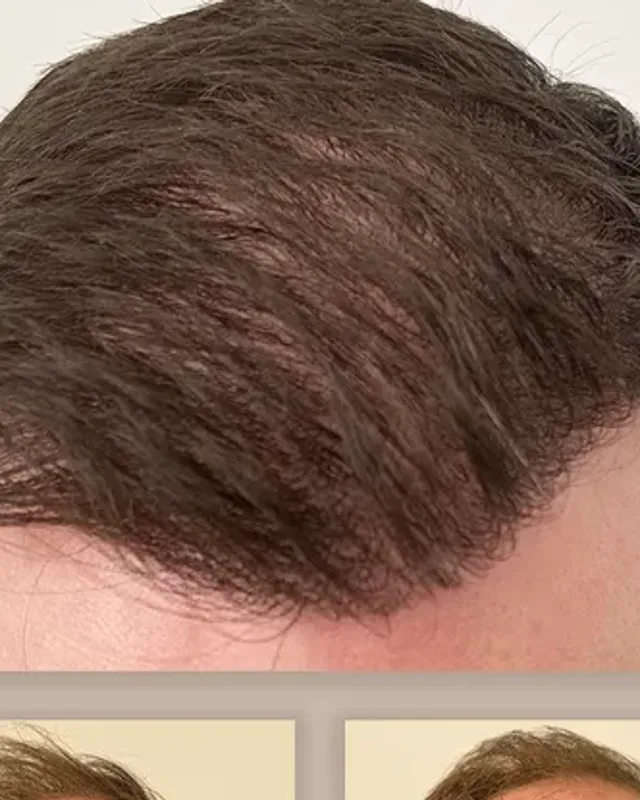Before and after hair transplant on a man, 4,000 grafts with the FUE method, result after 12 months