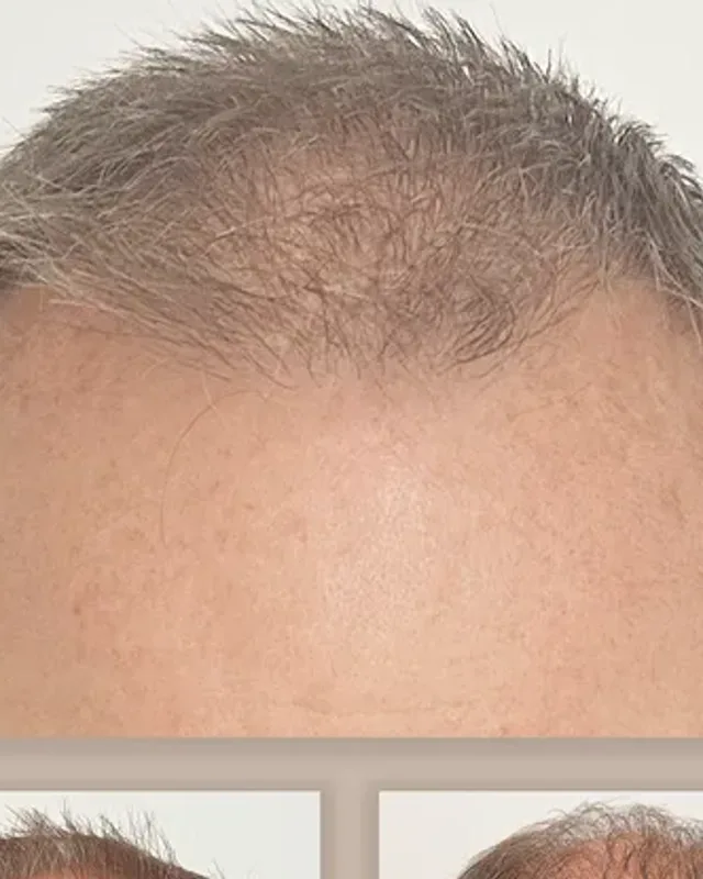 Before and after hair transplant on a man, 4,000 grafts with the FUE method, result after 18 months