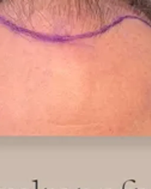 Before hair transplant, man